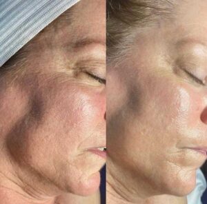 Before And After Hydrafacial Leeia Derma Spa