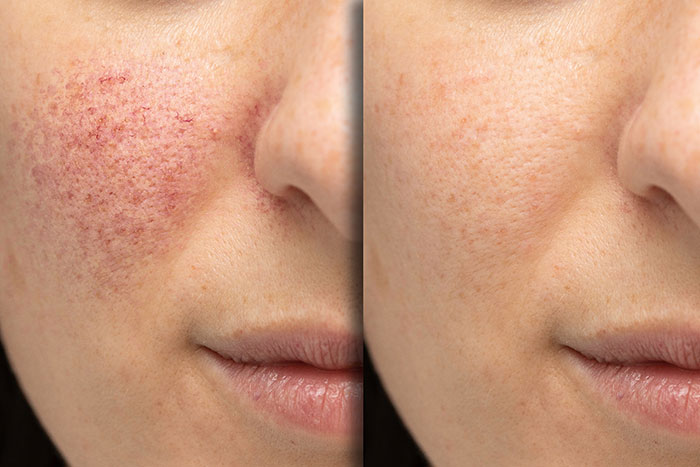 Leeia Derma Spa IPL Photofacial Before And After