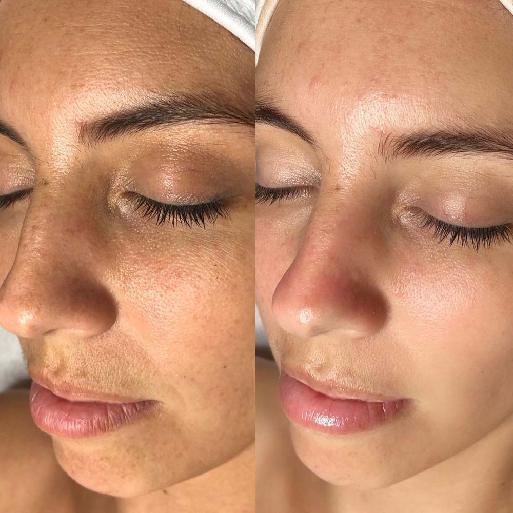 Before & After Oxygeneo Facial