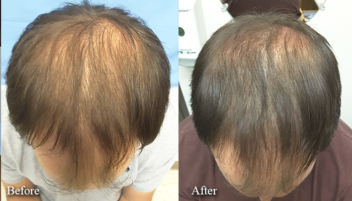 hair loss prp injection